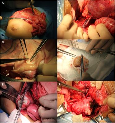 Bench surgery with autotransplantation for bilateral Wilms tumor—A feasible technique for renal sinus invasion